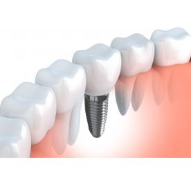 IMPLANTES DENTRIOS